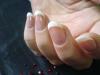 Псориаз ногтей: проявления болезни и лечение Лекарство от псориаза ногтей рук